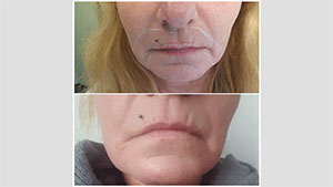 Gleichzeitige Entfernung von alter Lippenpigmentierung